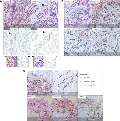 Analysis of Spatial Organization of Suppressive Myeloid Cells and Effector T Cells in Colorectal Cancer—A Potential Tool for Discovering Prognostic Biomarkers in Clinical Research